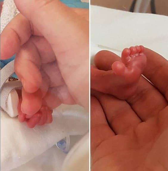 Hands and feet of premature twins